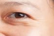 Cách xóa nếp nhăn vùng mắt hiệu quả mà bạn nên biết